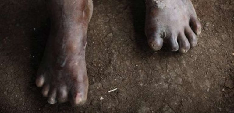 Leprosy patients groan as drug shortage persists for two years — Dermatologists